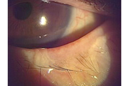 結膜炎 はやり目 よくある眼科疾患の解説 つつみ眼科クリニック 練馬区