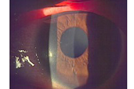 結膜炎 はやり目 よくある眼科疾患の解説 つつみ眼科クリニック 練馬区