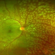 網膜レーザー治療