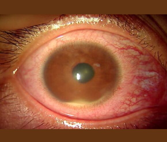 ベーチェット病