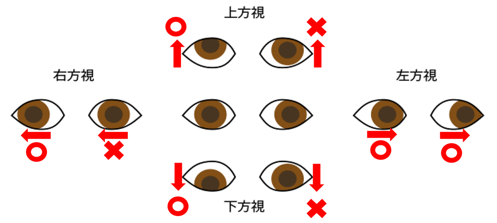 左動眼神経麻痺