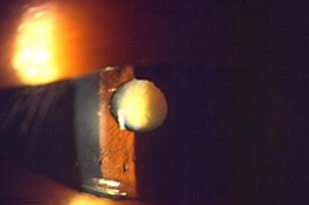 白内障(手術前)