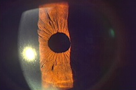 白内障(手術後)