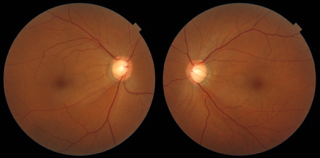 乳頭陥凹の拡大、視神経線維層欠損