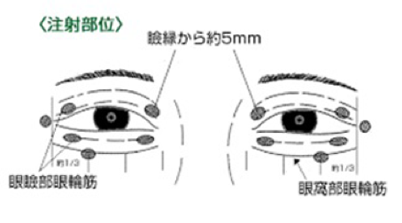 ボツリヌス毒素療法