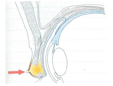押すと膿が出るタイプ