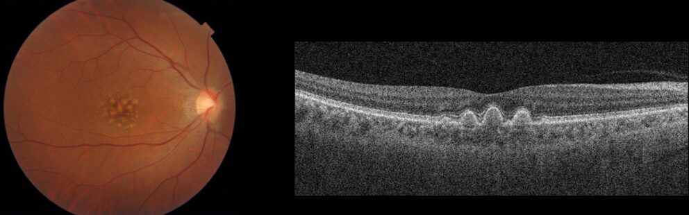 前駆病変ドルーゼン