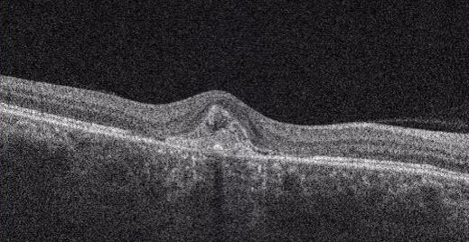 三次元眼底画像解析装置(OCT)