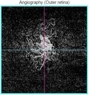 OCTアンギオグラフィー(OCTA)