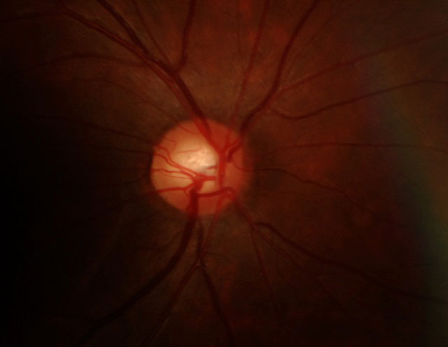 正常視神経乳頭