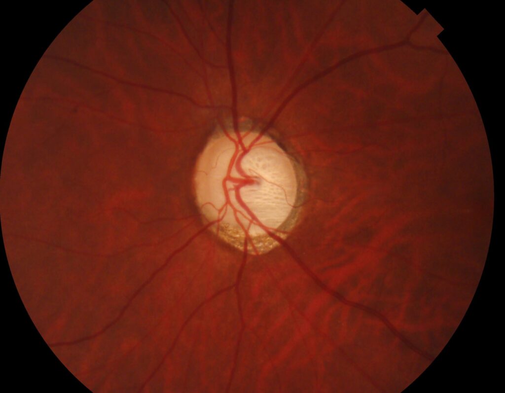 緑内障性視神経乳頭
視神経乳頭陥凹が拡大している