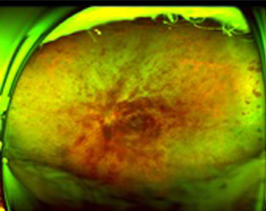 網膜中心静脈閉塞症