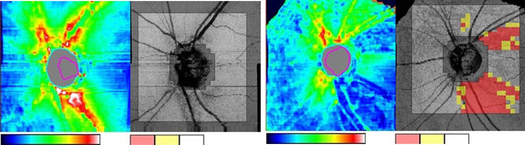 三次元眼底画像解析装置(OCT)