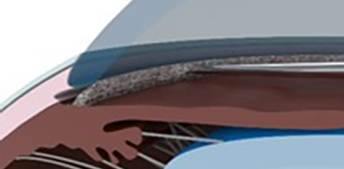 隅角を切開している図