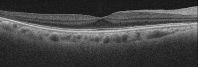 正常眼のOCT画像