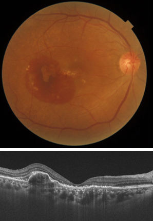 上図 / 加齢黄斑変性の眼底写真
下図 / 加齢黄斑変性のOCT図