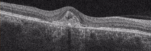 三次元眼底画像解析装置(OCT)