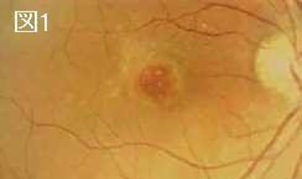 黄斑偽円孔