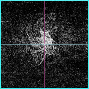 Angiography(Outer retina)