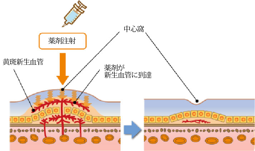 抗VEGF薬硝子体内注射