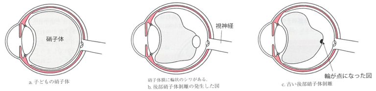 後部硝子体剥離