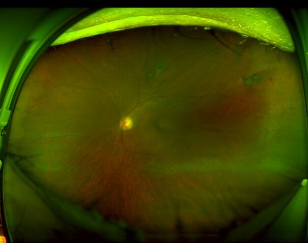 網膜裂孔レーザー前