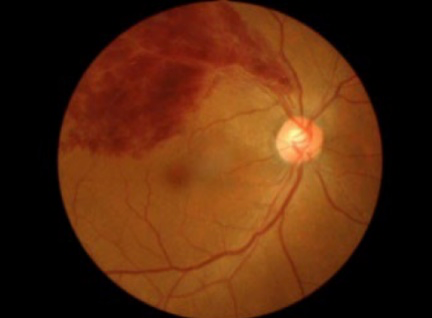 網膜静脈分枝閉塞