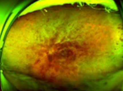 網膜中心静脈閉塞