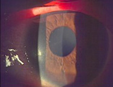 はやり目のあとにおこる点状表層角膜炎