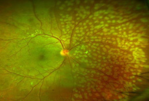 レーザー光凝固とは?