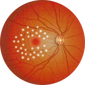 格子状光凝固(こうしじょうひかりぎょうこ)