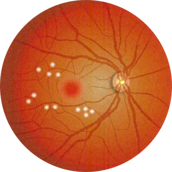 局所光凝固(きょくしょひかりぎょうこ)
