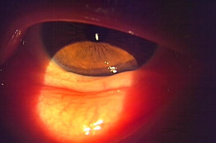 アレルギー性結膜炎浮腫