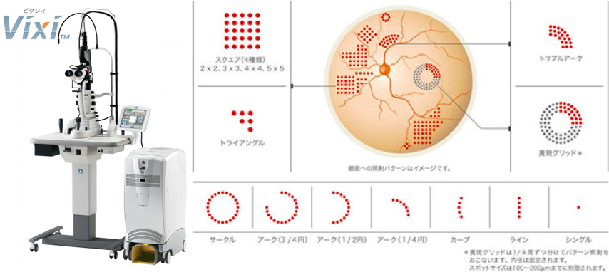 スキャンレーザー光凝固装置(NIDEK社)