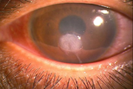 細菌による角膜感染症