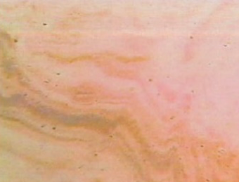 Grade3(軽症ドライアイ)