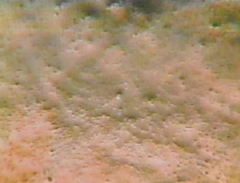 Grade5(重症ドライアイ)