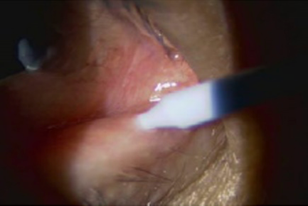 涙点プラグ挿入