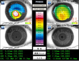 角膜形状解析装置(トポグラフイー)