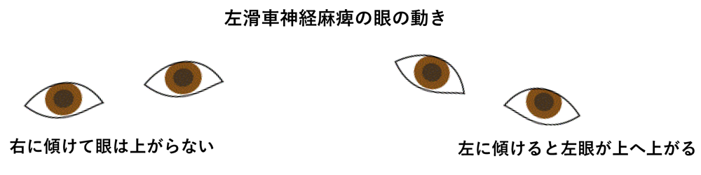左滑車神経麻痺の眼の動き