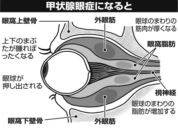 甲状腺眼症になると