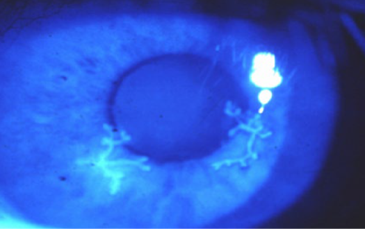 単純ヘルペスによる樹枝状角膜炎
