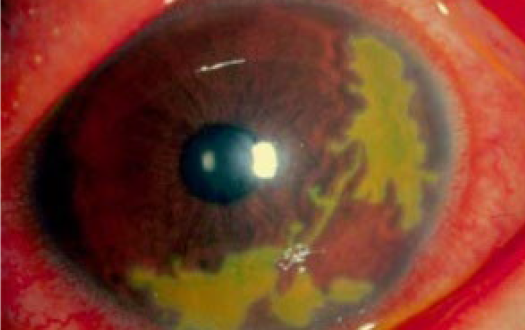 単純ヘルペスによる地図状角膜炎