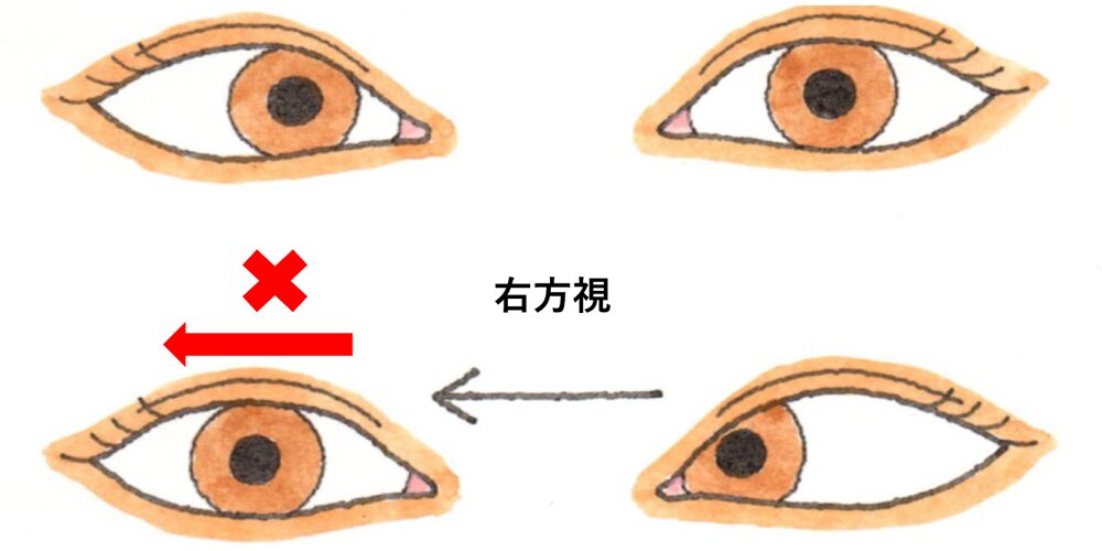 右外転神経麻痺