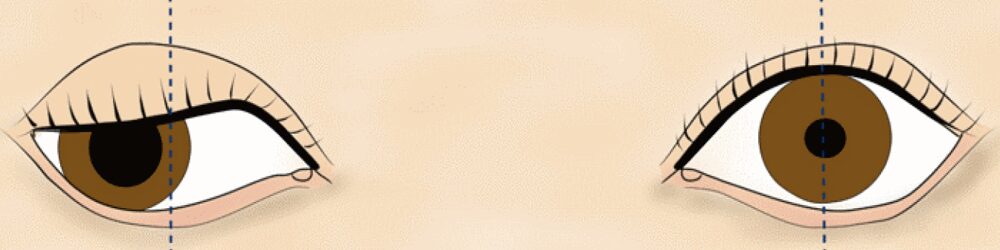 右眼瞼神経麻痺