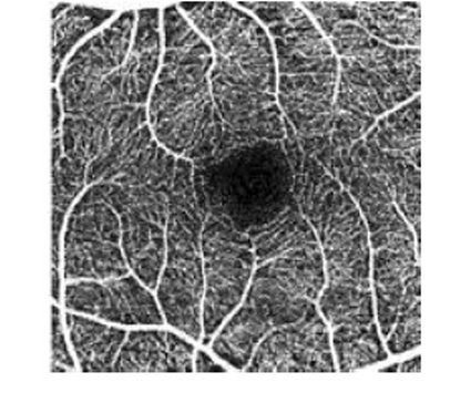 正常眼底網膜血管