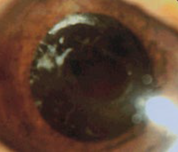 サルコイドーシス