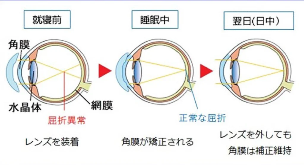 オルソケラトロジーレンズの仕組み