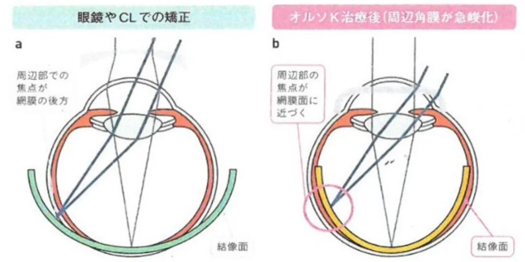 オルソケラトロジー 近視のメカニズム