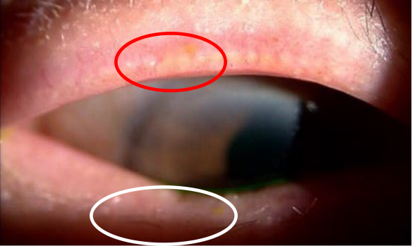 マイボーム腺機能不全